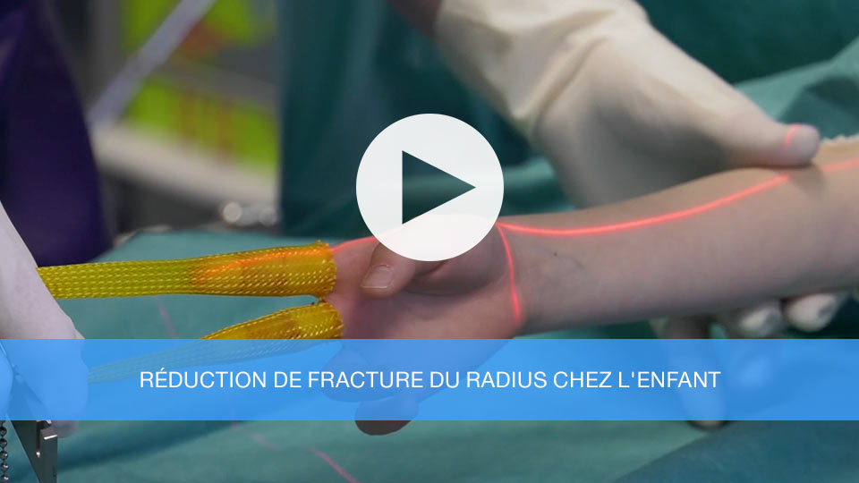 Réduction de fracture du radius chez l'enfant